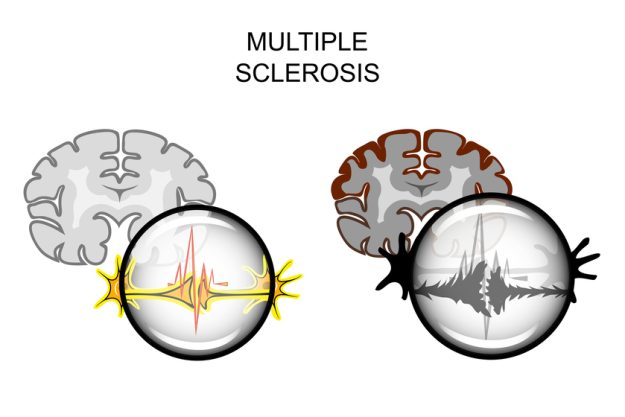 multiple sclerosis of the brain Multiple sclerosis of the brain