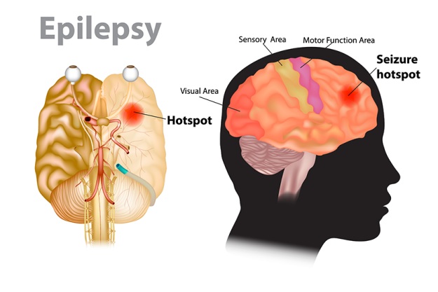 seizures-epilepsy-seizure-hotspot-medical-illustration-brain-epilepsy